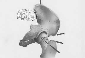 Behandlung komplexer Beschwerden von Hüfte, Iliosacralgelenk und Lendenwirbelsäule